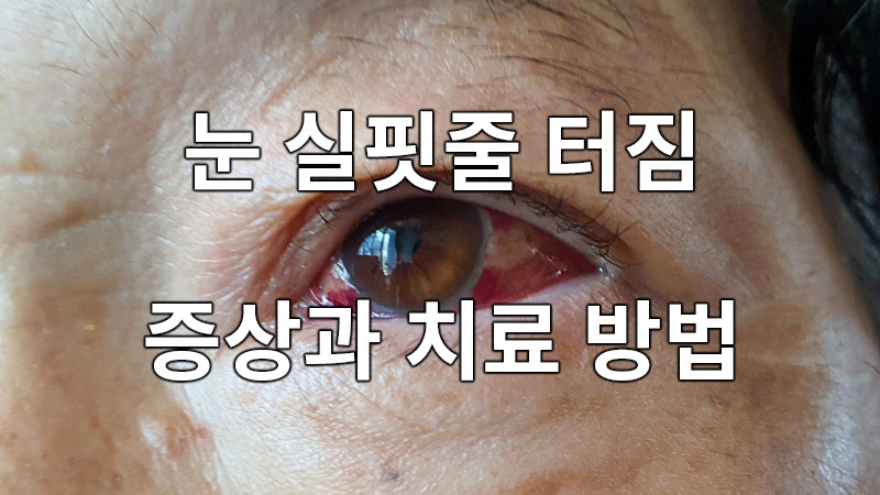 눈 실핏줄 터짐 증상과 치료 방법