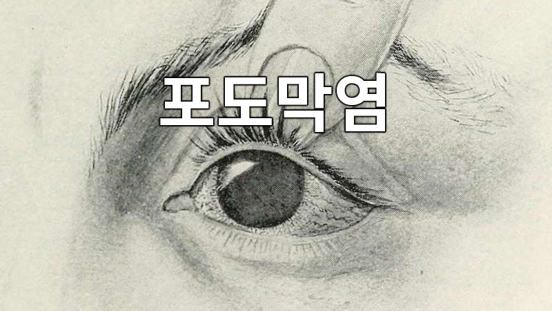 눈의 질병 포도막염 : 눈의 중간층인 포도막(홍채, 섬모체, 맥락막의 총칭)이 염증을 일으키는 상태