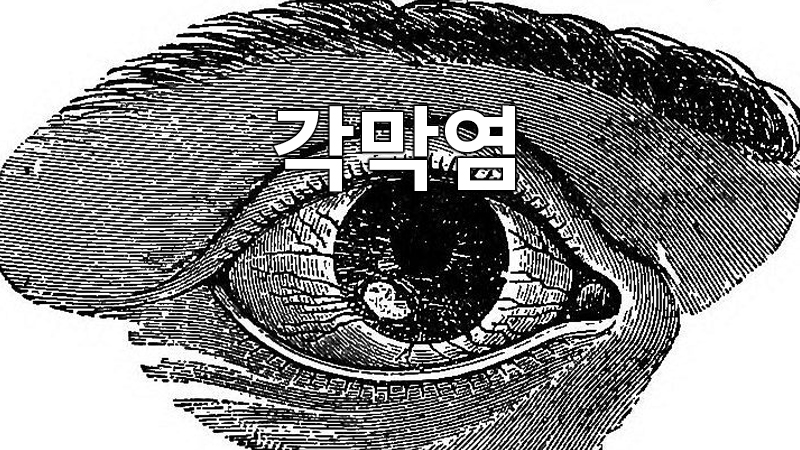 눈의 질환 각막염 : 눈의 앞부분에 위치한 투명한 조직인 각막이 염증을 일으키는 상태이며, 바이러스, 세균, 곰팡이, 기생충 등 다양한 원인에 의해 발생