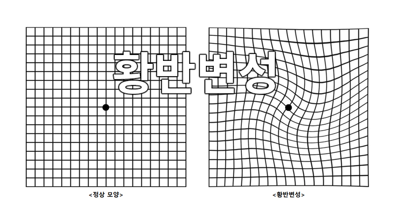 눈 질환 황반변성 : 망막의 중앙 부분인 황반에서 변성이 일어나는 질환