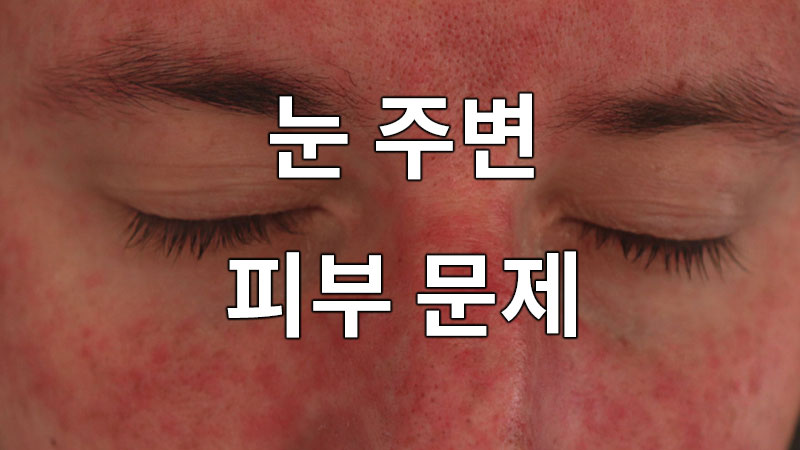 눈 주변 피부의 문제