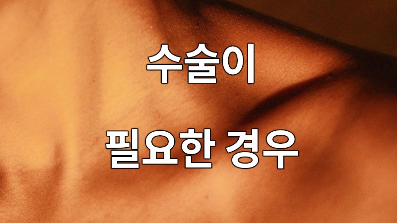 쇄골뼈 골절 수술이 필요한 경우