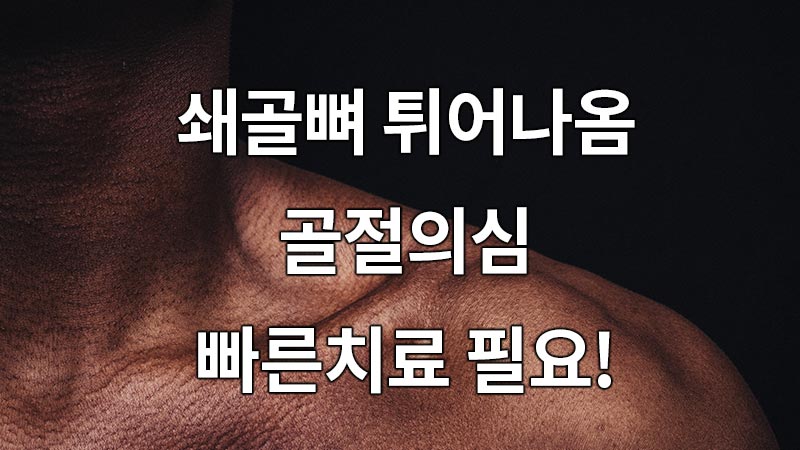 쇄골뼈 튀어나옴, 쇄골뼈 골절의심 빠른치료 필요!