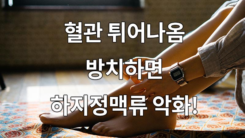 혈관 튀어나옴, 방치하면 '하지정맥류' 악화!