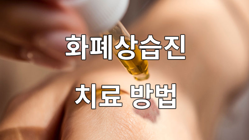 피부 도장병, 도장밥 화폐상습진 치료방법