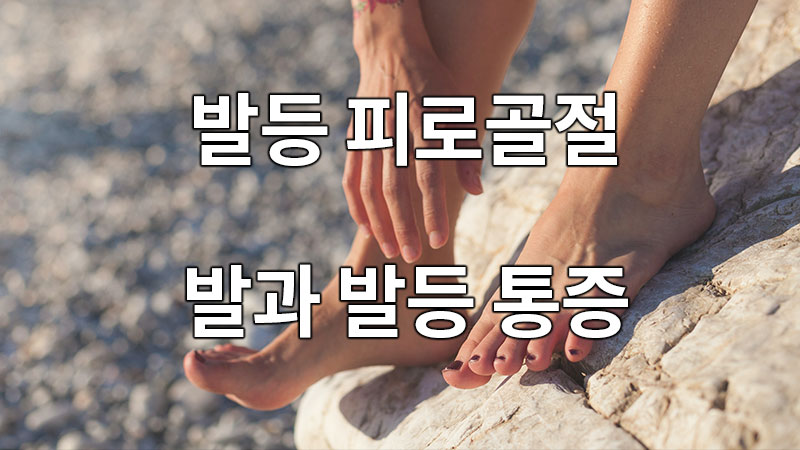 발등 피로골절, 발과 발등 통증, 걷기 어렵다면?