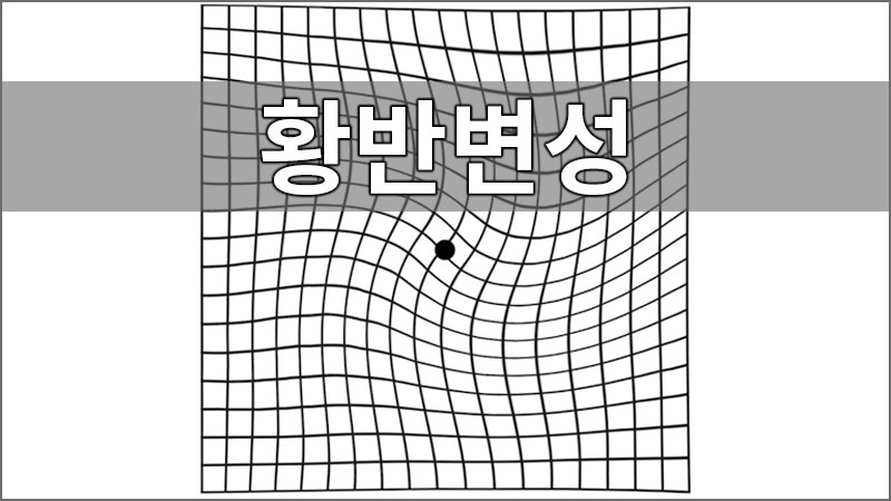 노인성 황반변성