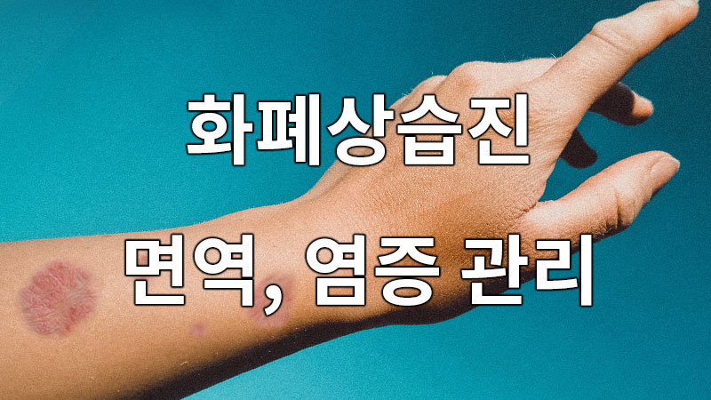 화폐상습진 면역, 염증 관리가 중요합니다.