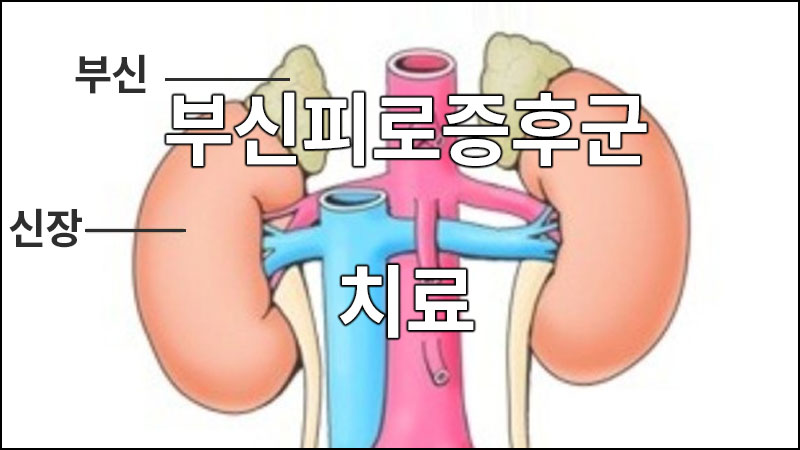 부신피로증후군의 치료