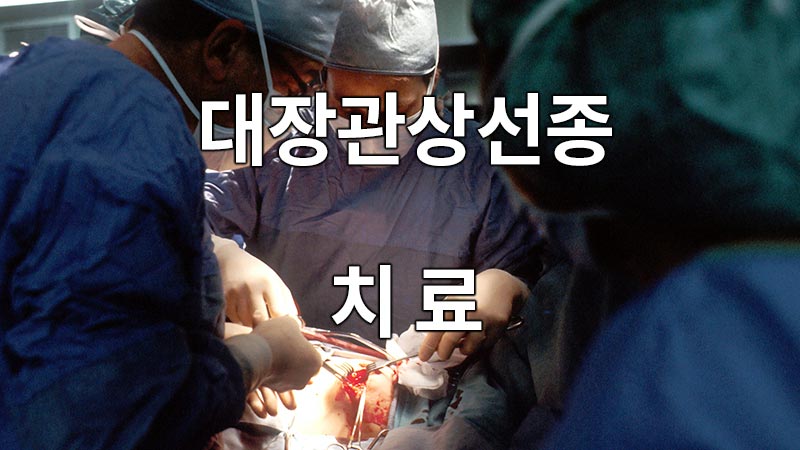 대장관상선종의 치료