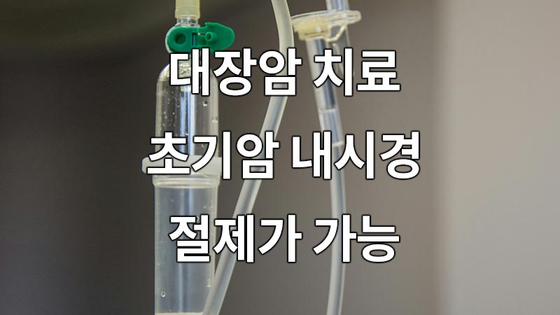 대장암 치료, 초기암 내시경 절제가 가능