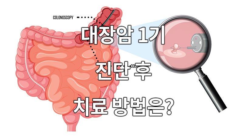 대장암 1기 진단 후 치료 방법은?