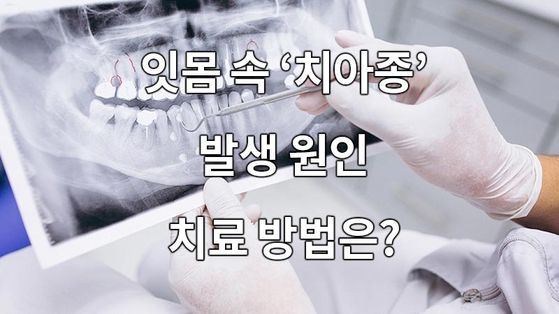 잇몸 속 치아종 발생 원인과 치료 방법은?
What is the cause and treatment for the gum's glioma?
