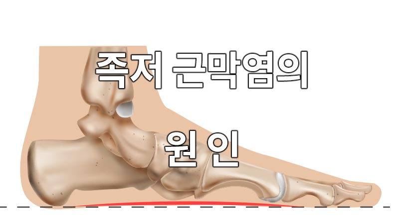 발 뒤꿈치 통증, 족저 근막염의 원인