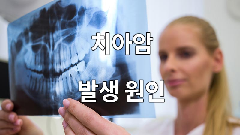 치아암 발생 원인
Causes of dental cancer
