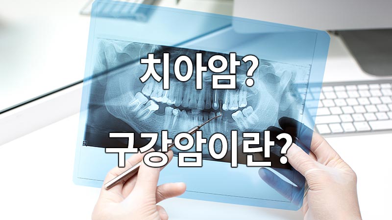 치아암이란?
What is dental cancer?
