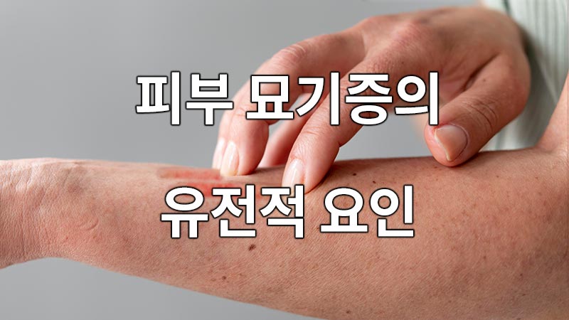 피부 묘기증의 유전적 요인
Genetic Factors in Skin Surgery
