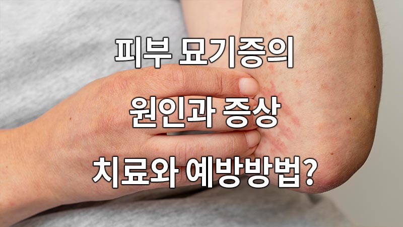 피부 묘기증의 원인과 증상, 치료와 예방방법은?
What are the causes, symptoms, and treatment and prevention methods of skin stunting?
