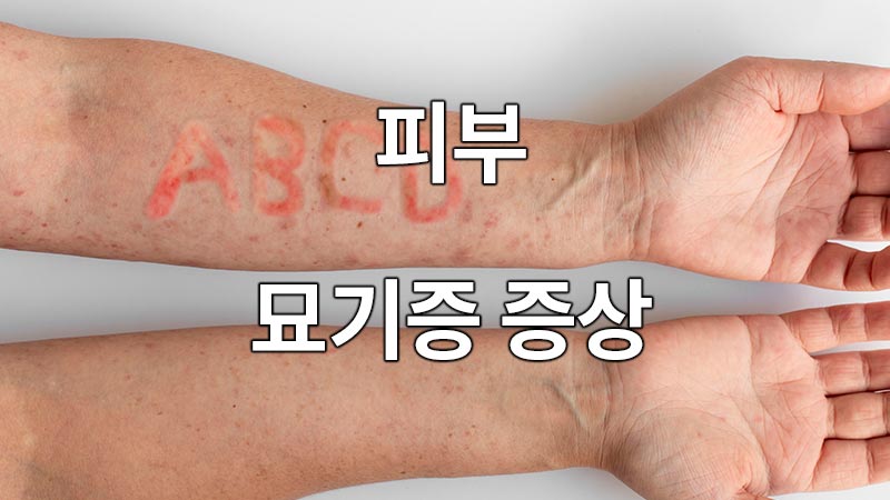 피부 묘기증의 증상
a symptom of skin stunting
